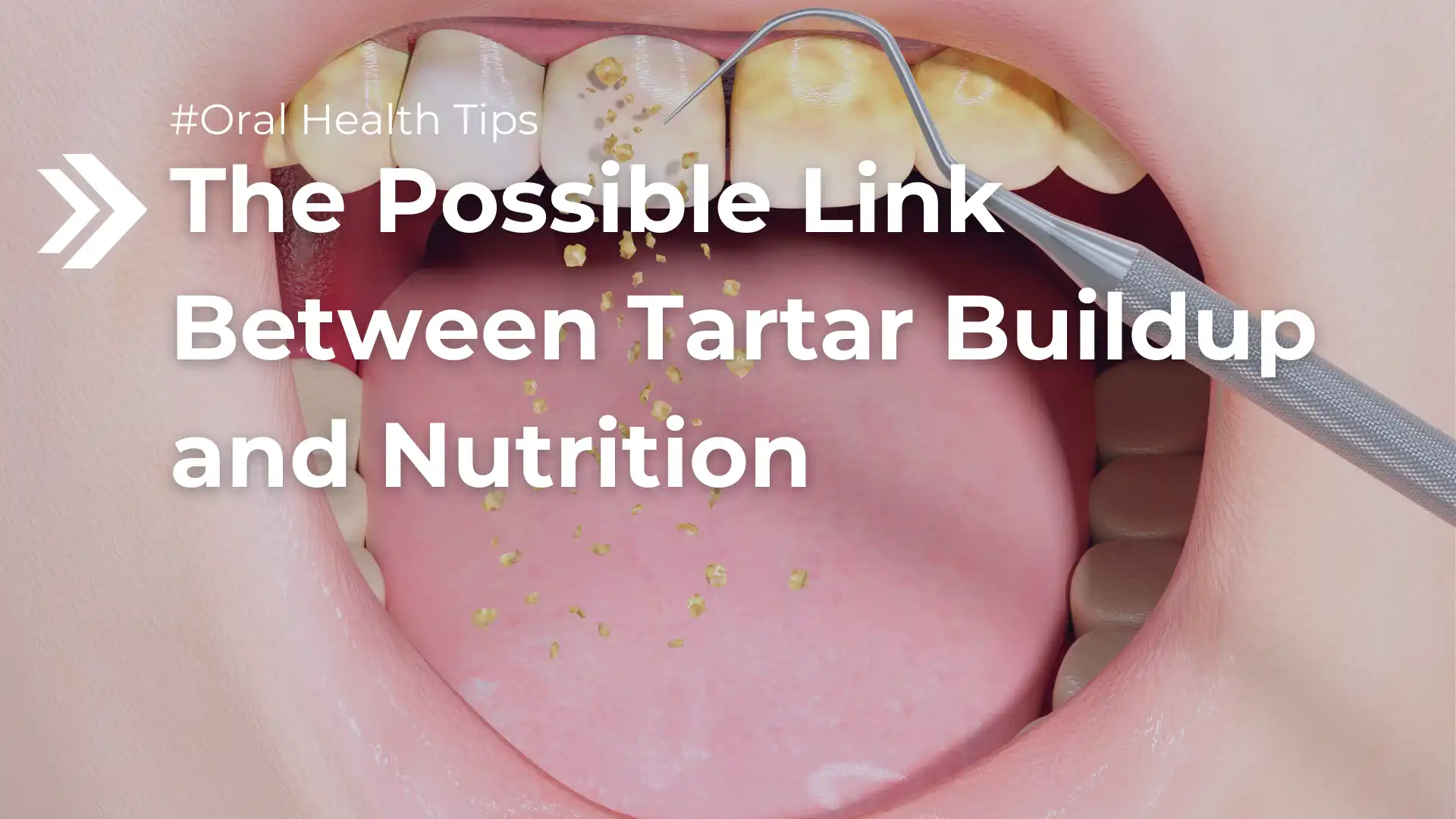 The Possible Link Between Tartar Buildup and Nutrition image