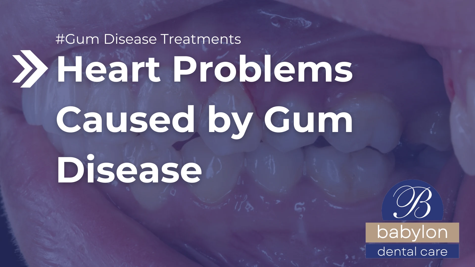 Heart Problems Caused by Gum Disease Image - new logo