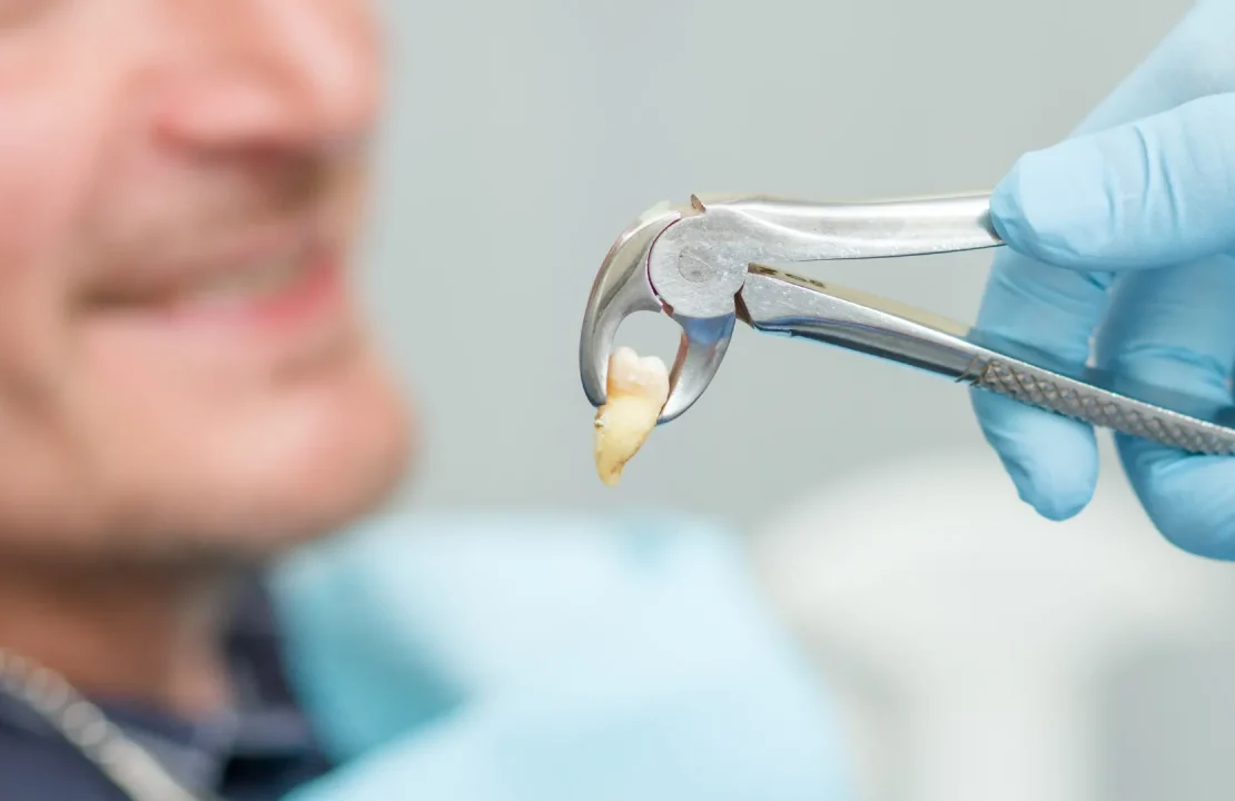 How to Avoid a Dry Socket After a Tooth Extraction Image raw