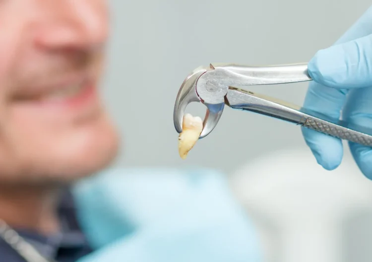 How to Avoid a Dry Socket After a Tooth Extraction Image raw